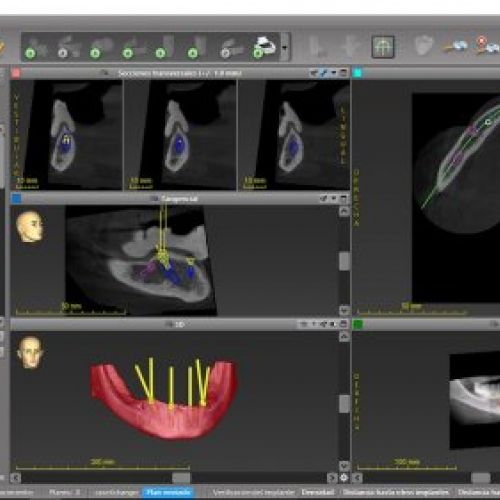 Cirugía Guiada Codiagnostix