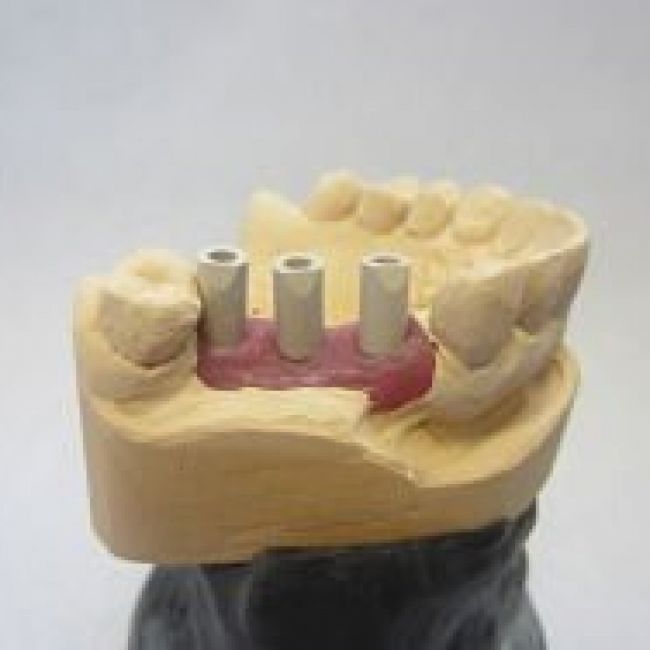 Escaneado Cad Cam