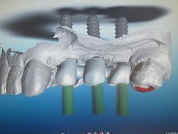 laboratorio prótesis dental gijón