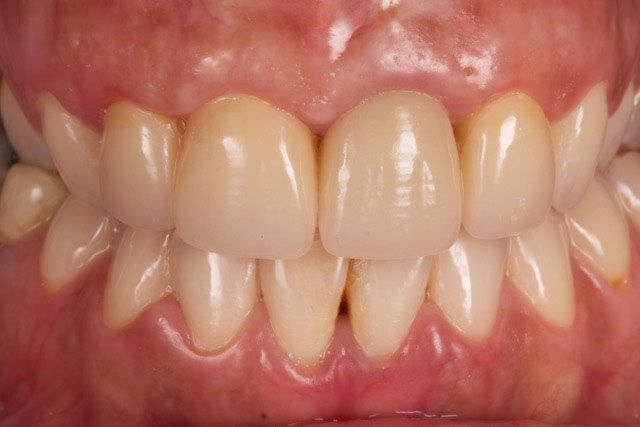 Carillas de Disilicato de Litio (E max)