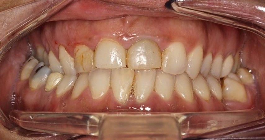 Dentadura antes del tratamiento