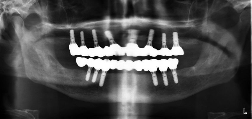 Implante de cromo cobalto