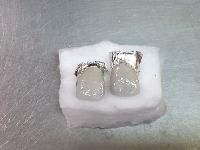 Microcarillas dentales terminadas