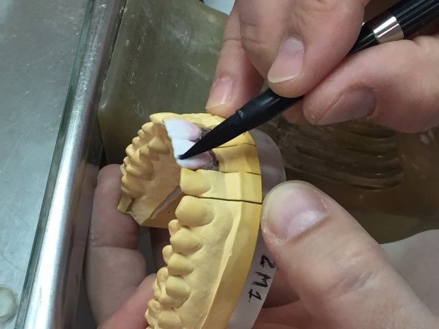 Retoque de carillas sobre molde dental
