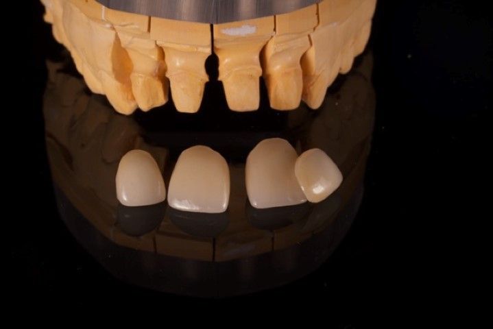 Estudio para carillas estéticas