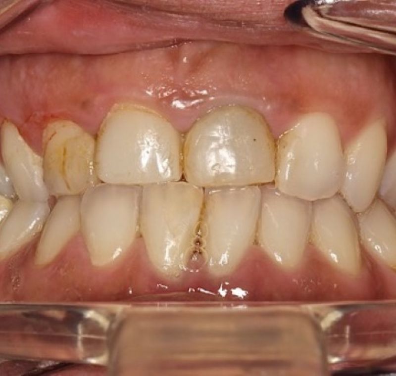 Dentadura antes del tratamiento
