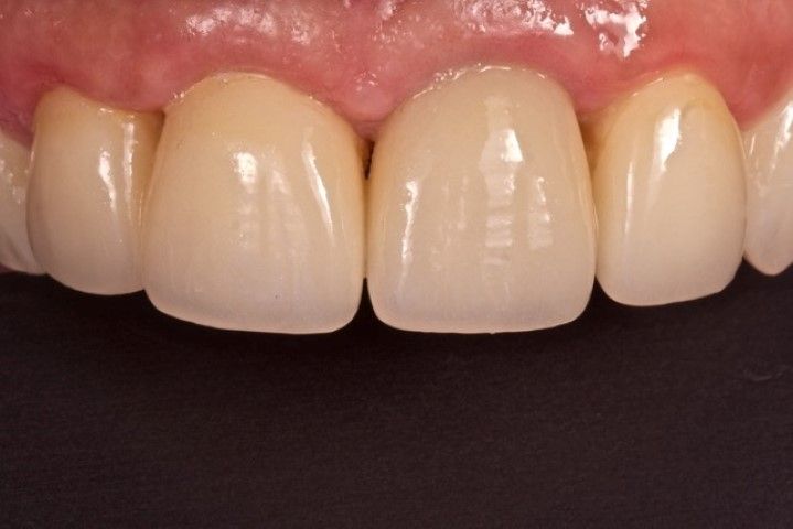 Dientes arreglados con carillas