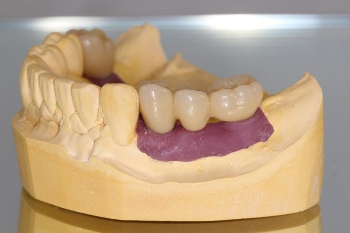 Restauración circonio cerámica sobre Vario Base