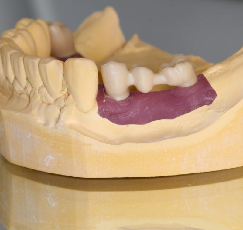Estructura de circonio sobre Vario Base