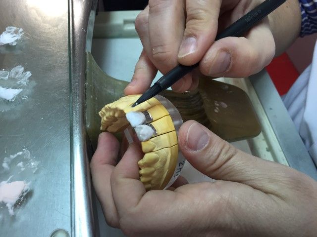 Retoques de microcarillas sobre molde dental