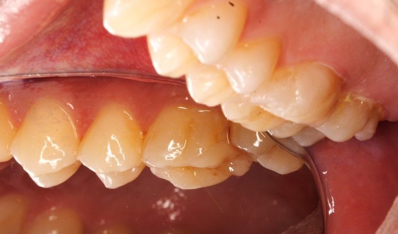 Preparación dental para incrustación