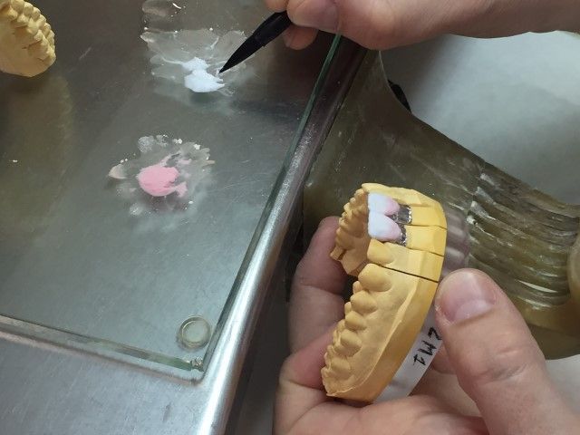 Coloración de microcarillas dentales