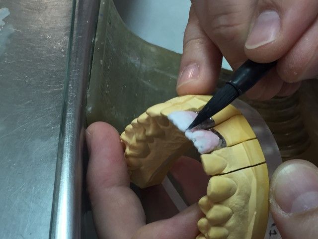 Detalle de trabajo sobre pieza dental