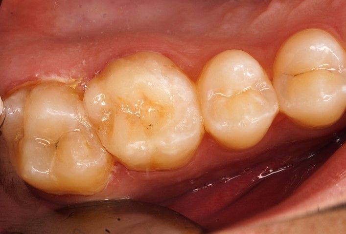 Restauración dental con e max