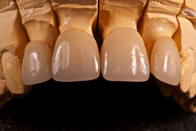 Preparación de las carillas