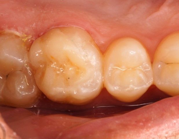 Detalle de restauración dental