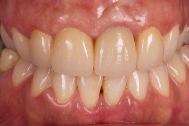 Dentadura después del tratamiento