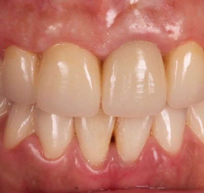 Carillas de Disilicato de Litio (E max)