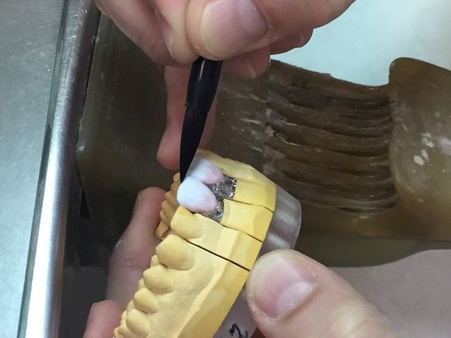 Carillas de porcelana ultra delgadas