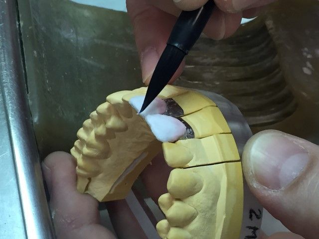 Ajuste de carillas dentales