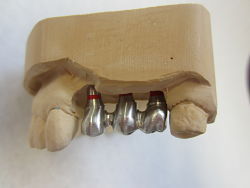laboratorio prótesis dental asturias